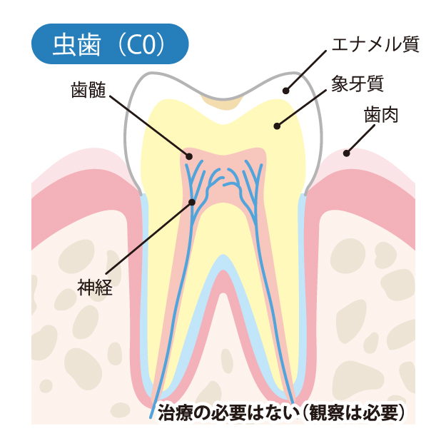 インターパーク（宇都宮・雀宮）の歯医者、こうだい歯科のMI治療