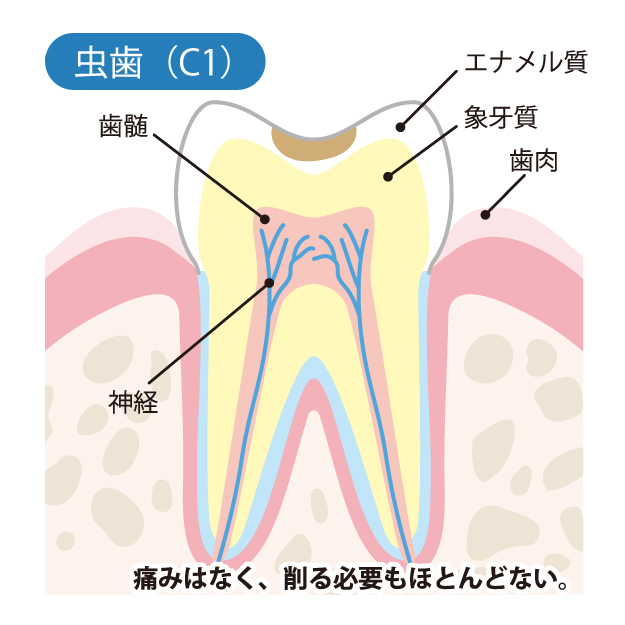 インターパーク（宇都宮・雀宮）の歯医者、こうだい歯科のむし歯治療