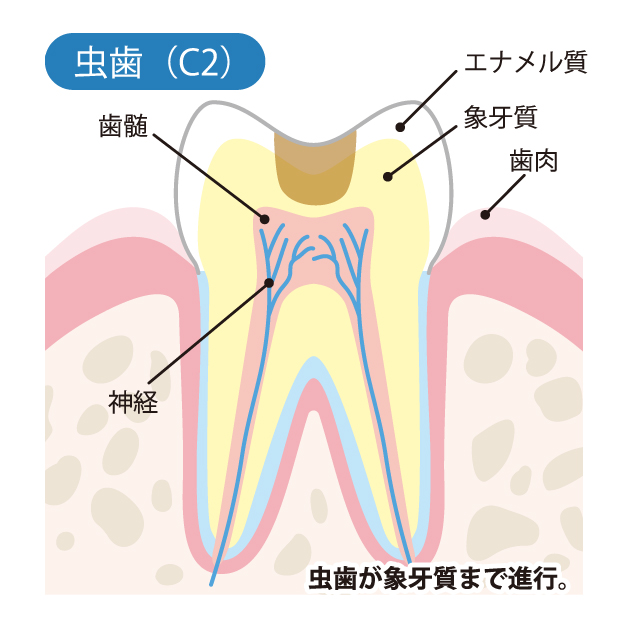 インターパーク（宇都宮・雀宮）の歯医者、こうだい歯科のむし歯治療