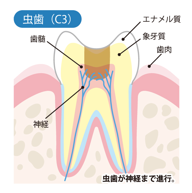 インターパーク（宇都宮・雀宮）の歯医者、こうだい歯科のむし歯治療