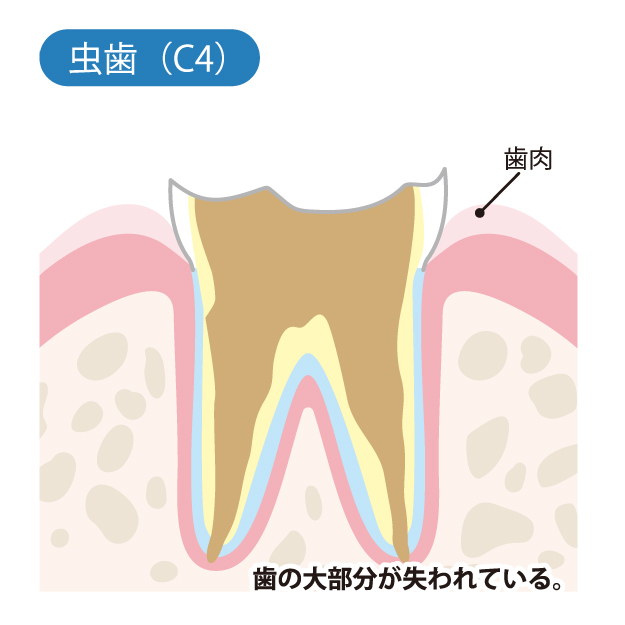 インターパーク（宇都宮・雀宮）の歯医者、こうだい歯科のむし歯治療