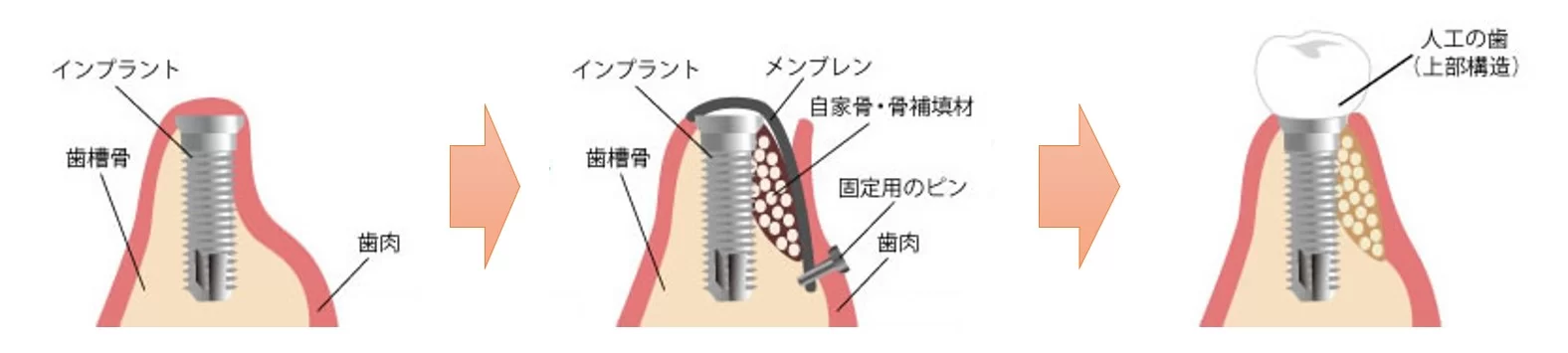 インターパーク（宇都宮・雀宮）の歯医者、こうだい歯科のGBR法