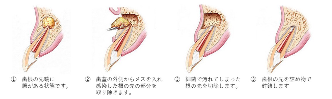 インターパーク（宇都宮・雀宮）の歯医者、こうだい歯科のファイバーコア