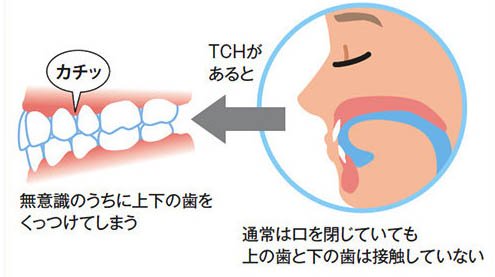 インターパーク（宇都宮・雀宮）の歯医者、こうだい歯科の歯列接触癖対策