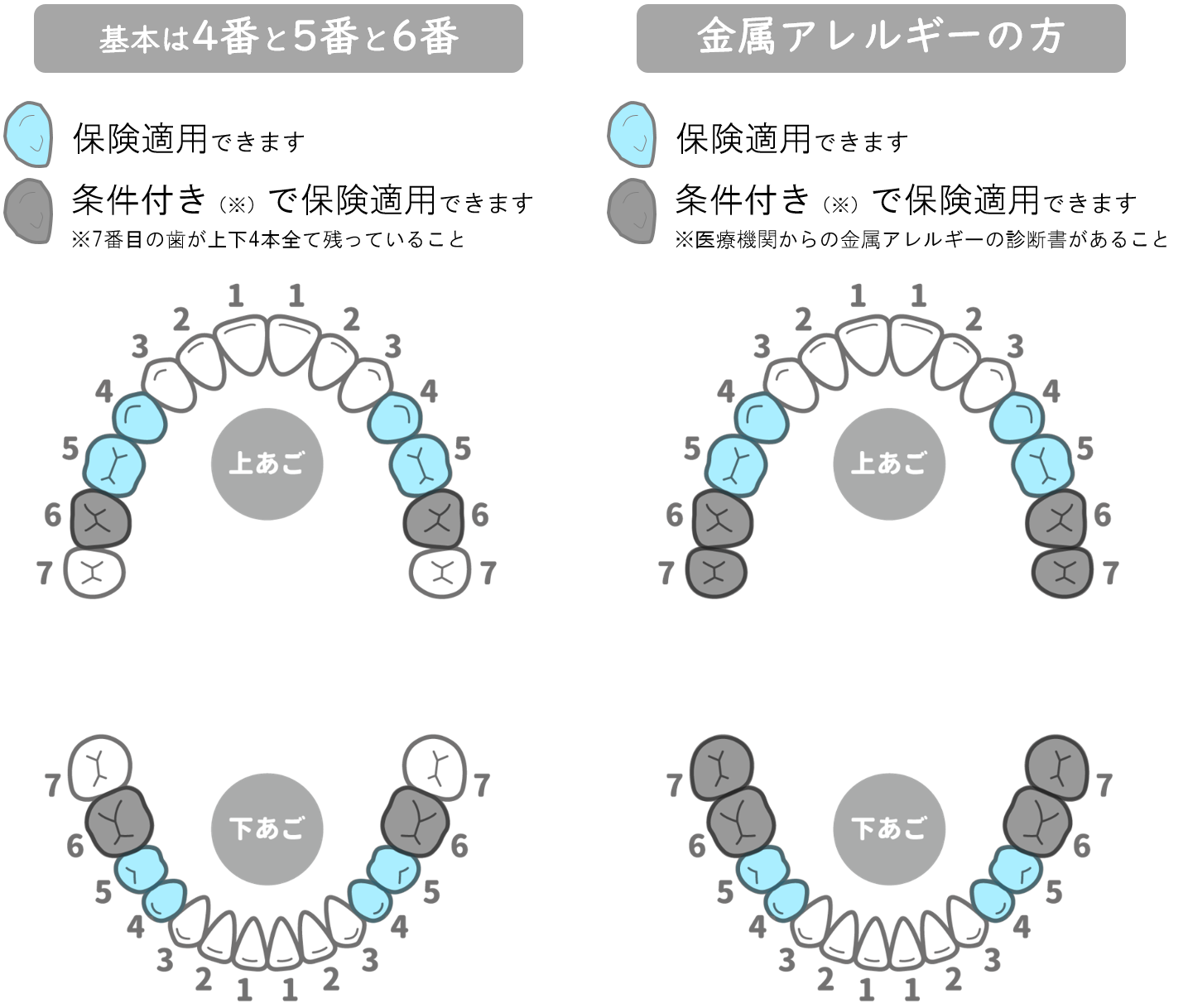 インターパーク（宇都宮・雀宮）の歯医者、こうだい歯科で保険診療でも「白い歯」に