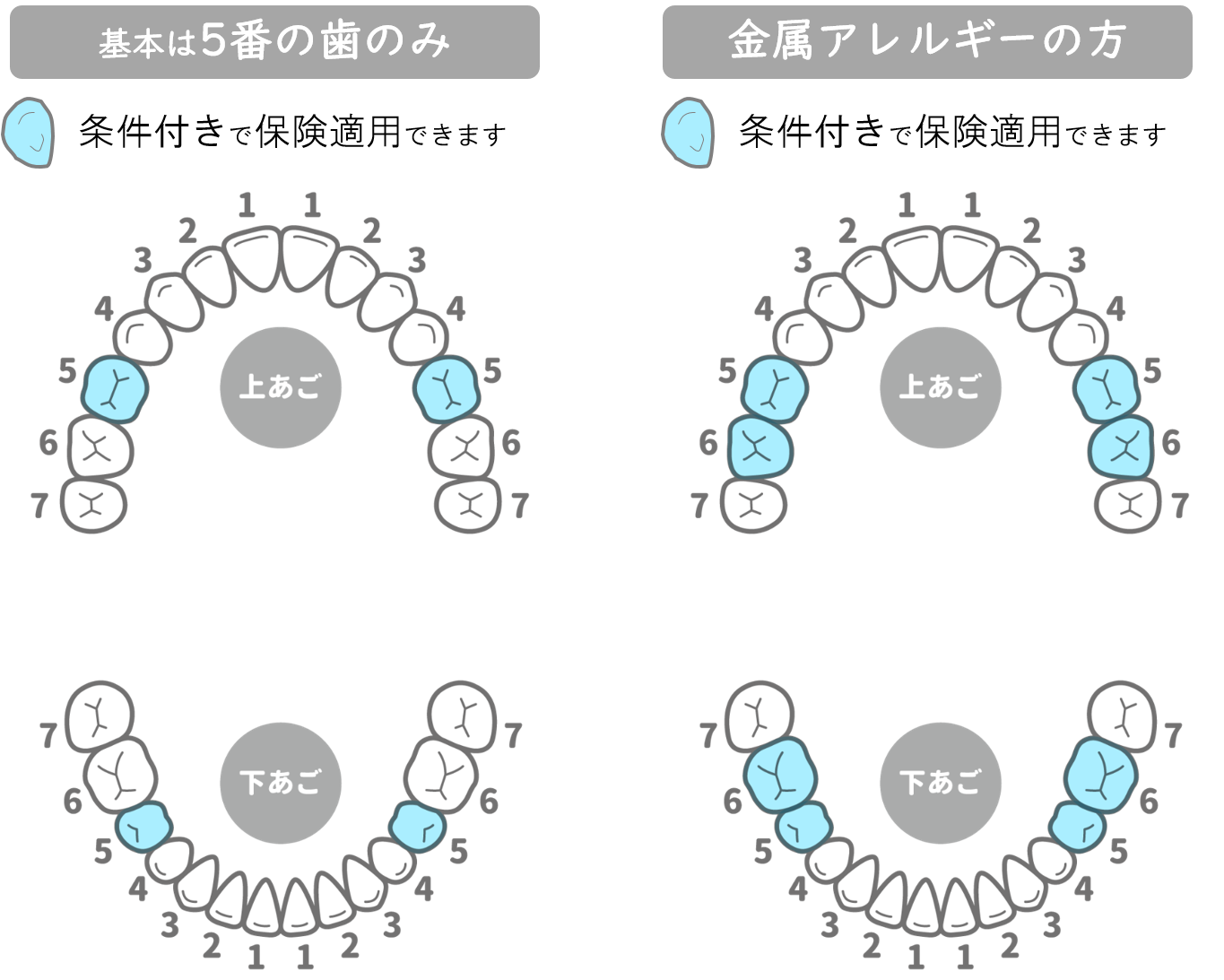 インターパーク（宇都宮・雀宮）の歯医者、こうだい歯科で保険診療でも「白い歯」に