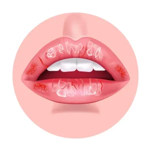 宇都宮市(雀宮、上三川町)の歯医者、こうだい歯科で口の端が切れやすい原因について解説