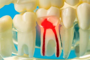 宇都宮市(雀宮、上三川町)のこうだい歯科で乳歯の「ピンク歯」はなぜ起こる？原因や治療法を解説