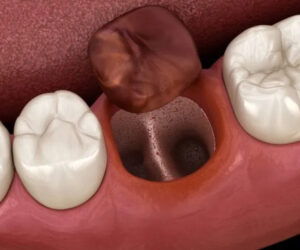 宇都宮市(雀宮、上三川町)のこうだい歯科で乳歯の「ピンク歯」はなぜ起こる？原因や治療法を解説