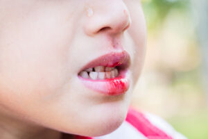 宇都宮市(雀宮、上三川町)のこうだい歯科で乳歯の「ピンク歯」はなぜ起こる？原因や治療法を解説