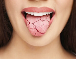 宇都宮市(雀宮、上三川町)のこうだい歯科で薬剤性ドライマウスについて解説