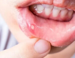 宇都宮市(雀宮、上三川町)のこうだい歯科で舌を噛む癖が歯並びに与える影響を解説