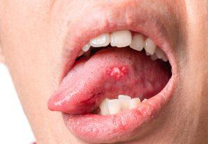 宇都宮市(雀宮、上三川町)のこうだい歯科で舌を噛む癖が歯並びに与える影響を解説