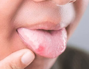 宇都宮市(雀宮、上三川町)のこうだい歯科で舌を噛む癖が歯並びに与える影響を解説