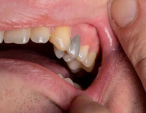 宇都宮市(雀宮、上三川町)のこうだい歯科で子どもの歯がグレーに変色した？歯の変色の原因と治療法を解説