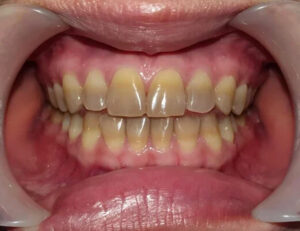 宇都宮市(雀宮、上三川町)のこうだい歯科で子どもの歯がグレーに変色した？歯の変色の原因と治療法を解説