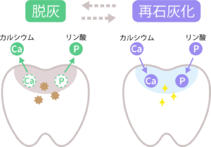 宇都宮（雀宮）の歯医者、こうだい歯科で、冷たいものがしみるのは虫歯？知覚過敏との見分け方と治療法を解説