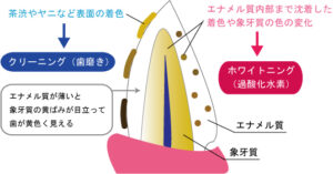 宇都宮（雀宮）の歯医者、こうだい歯科で、ホワイトニングで白くならない歯がある？テトラサイクリン歯や失活歯の改善法を解説